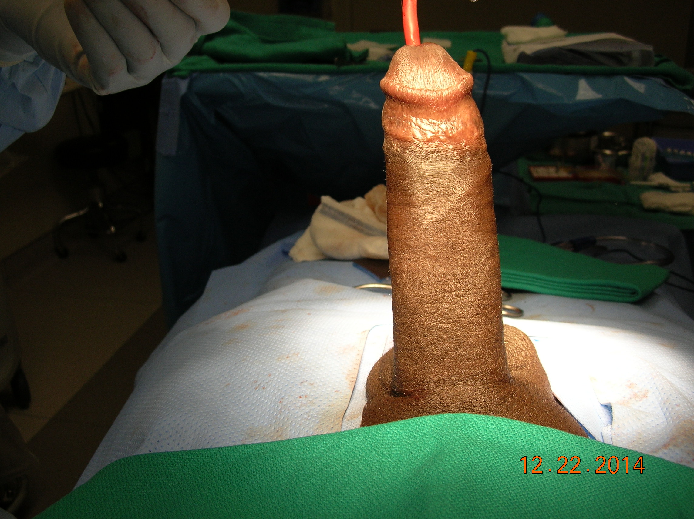 Impotence Penile Implant Example 6